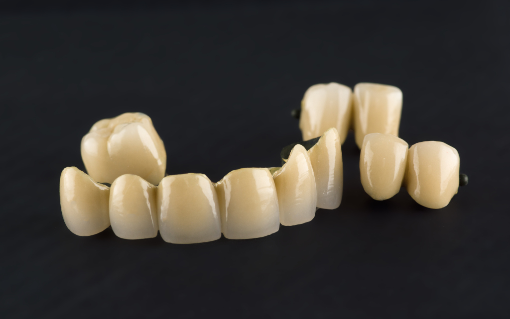 Найдоступніший варіант при втраті зубів - металокерамічні коронки